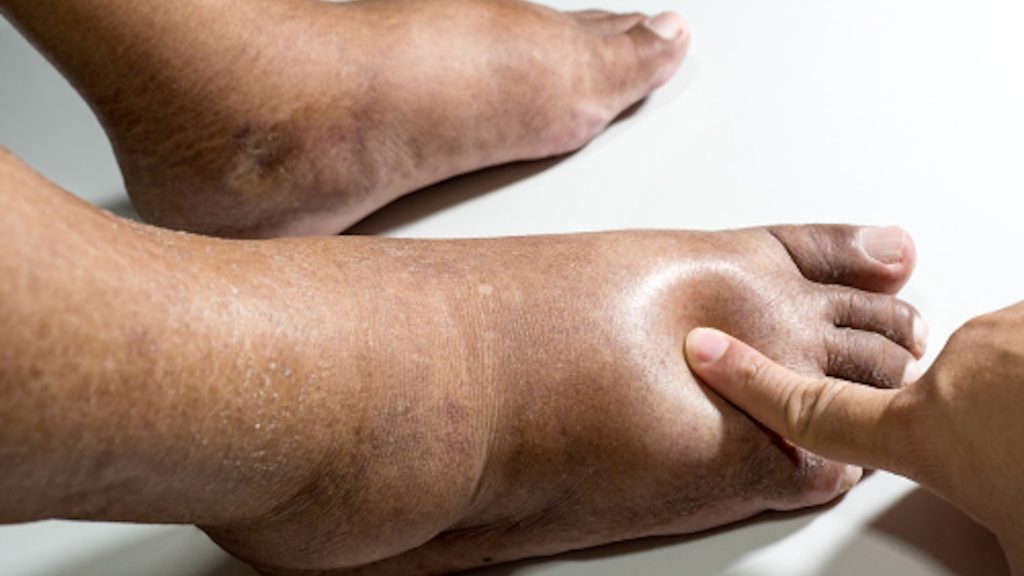 swollen feet 1024x576 1