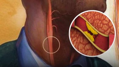 10 Signs Youre Living With Clogged Arteries0 1