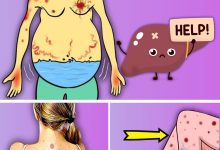 5 Silent Symptoms of Fatty Liver You Must Never Ignore