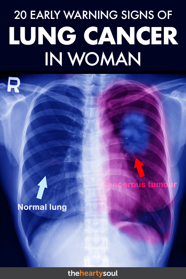 Aug09 Lung Cancer