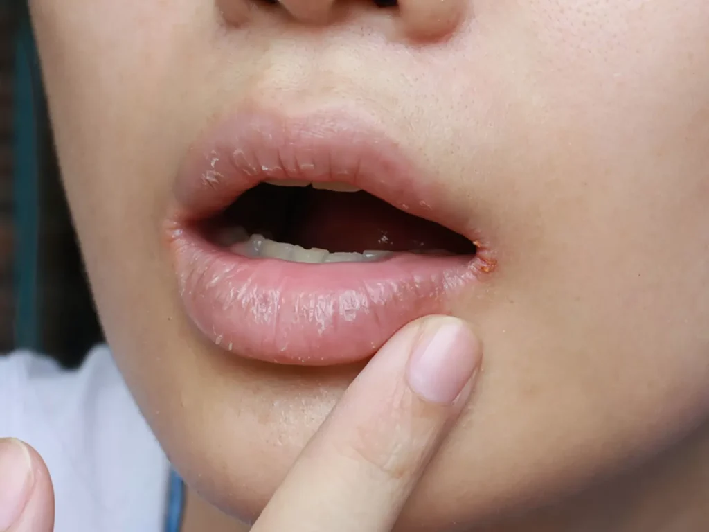 Common Reasons Your Lip Corners Are Cracking 1024x768 1