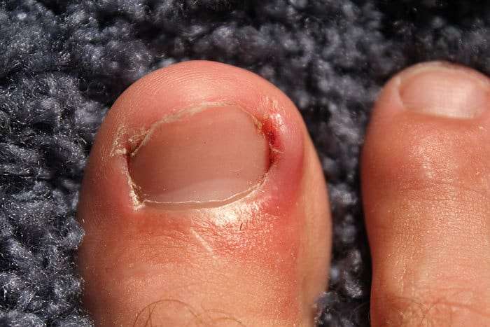 Ingrown Toe Nails 2