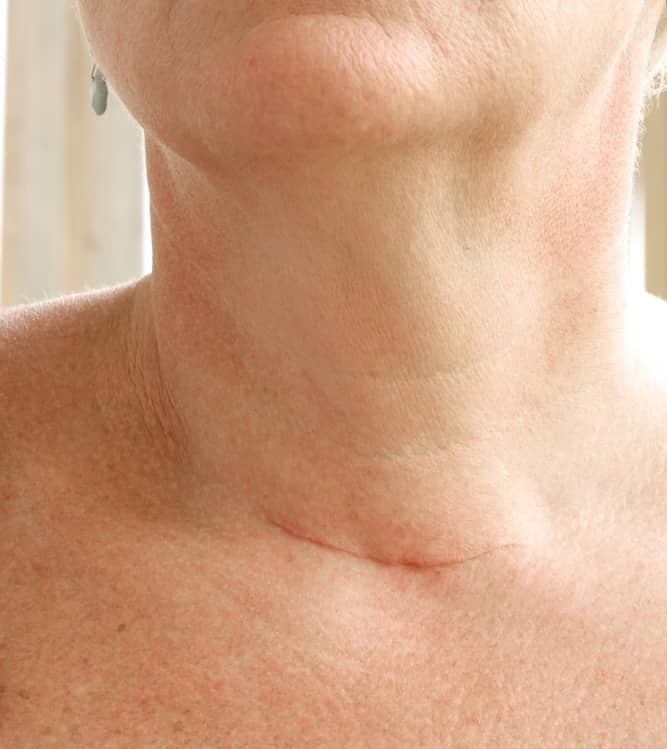 neck scar thyroid glands removal