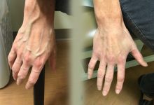 DV visible veins2