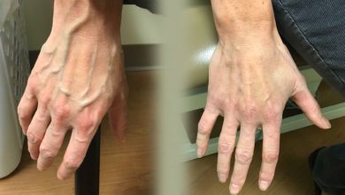 DV visible veins2