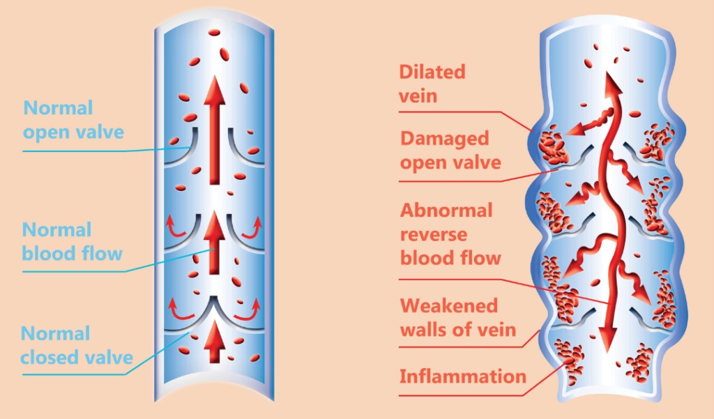 vein swelling 1024x601 1